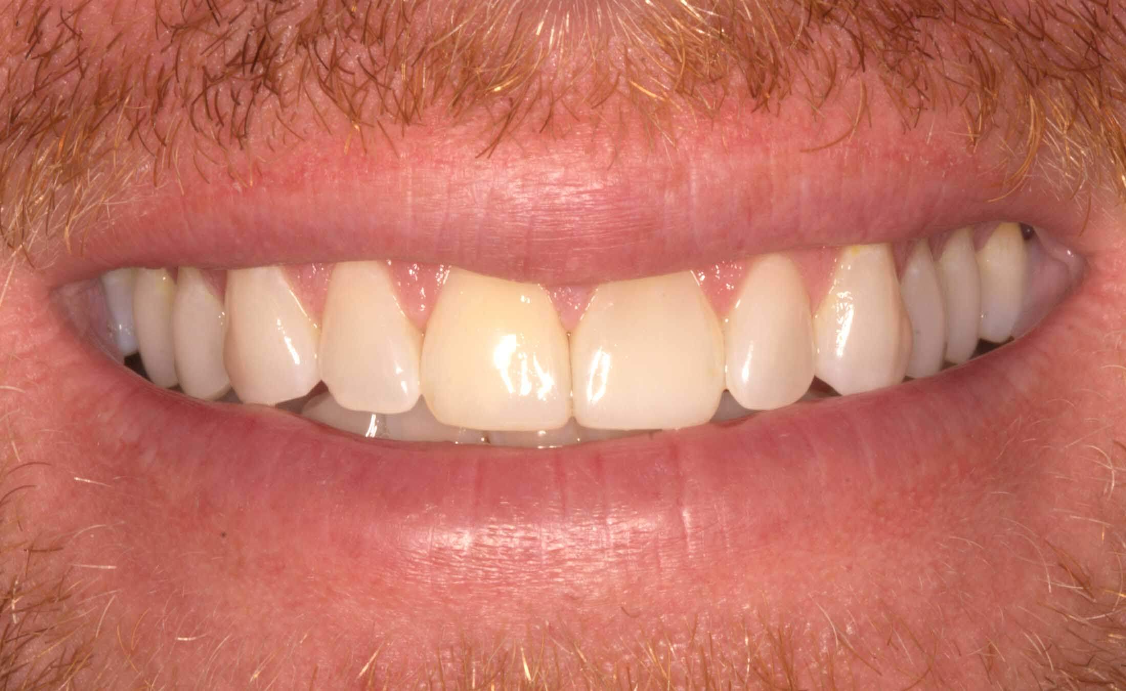 Pat Closeup After Tooth Bonding