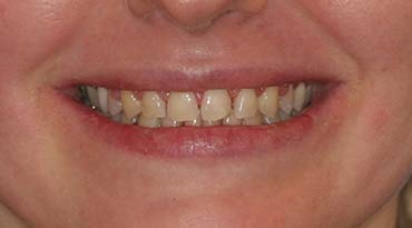 esthetic-treatment-plan-montgomery-dental-care-c