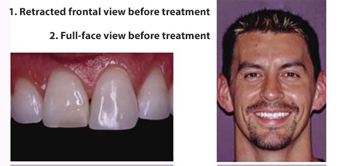 Type IV Direct Dental Resin Restoration