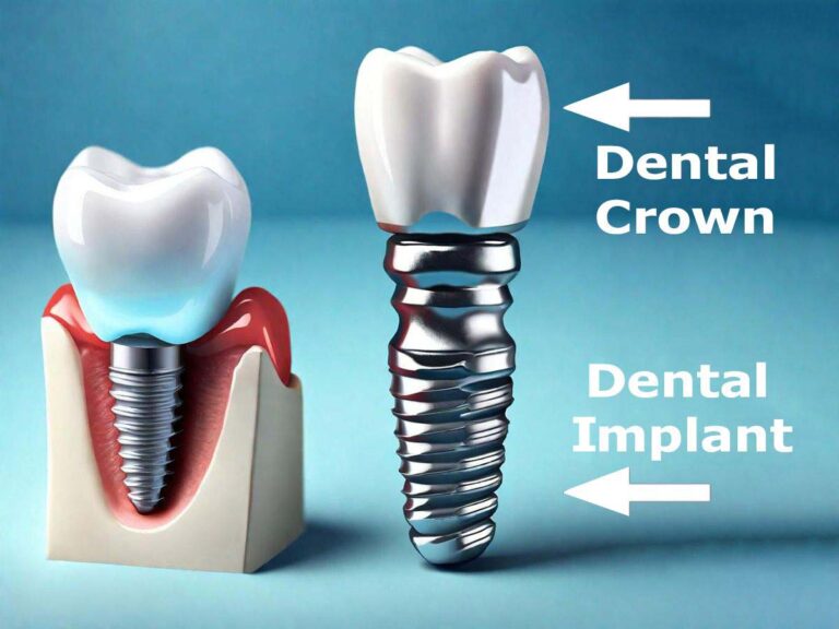 Understand the Difference Between Dental Crowns and Dental Implants